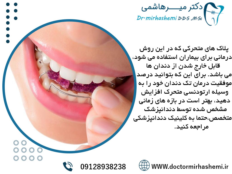 ارتودنسی متحرک برای تک دندان