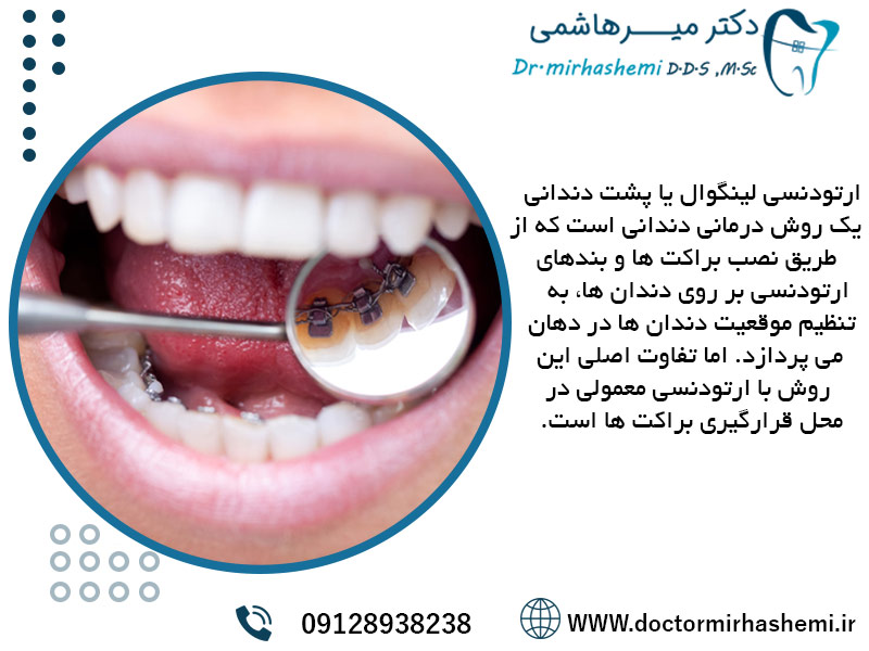 منظور از ارتودنسی لینگوال یا پشت دندانی چیست