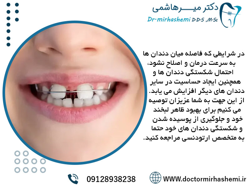 دیاستما یا فاصله بین دندان ها چیست
