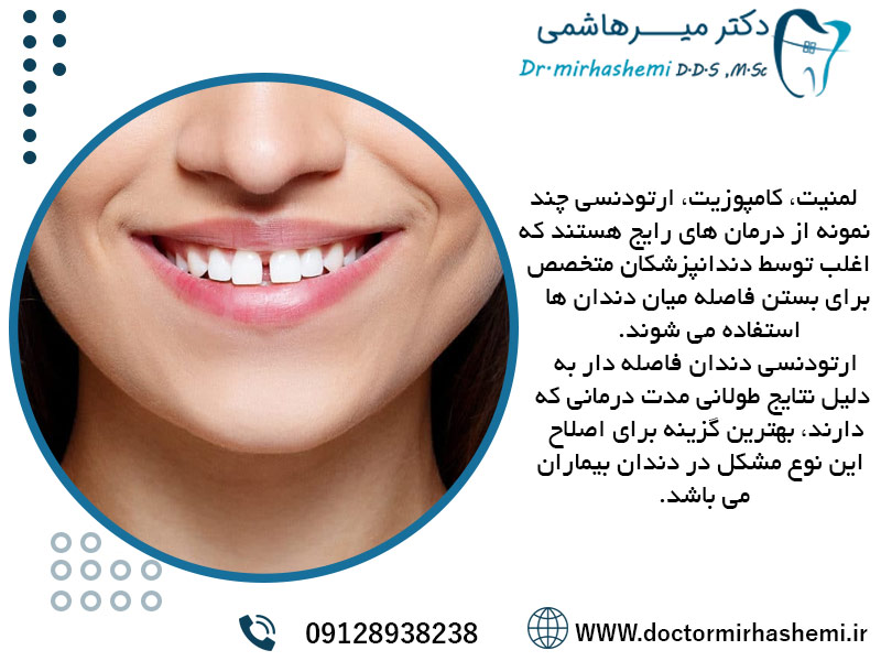 لمینت، کامپوزیت، ارتودنسی کدام روش برای بستن فاصله میان دندان مناسب تر است