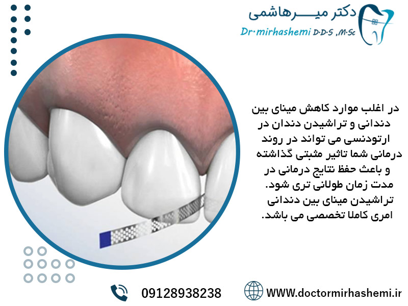 کاهش مینای بین دندانی می تواند به درمان ارتودنسی کمک کند
